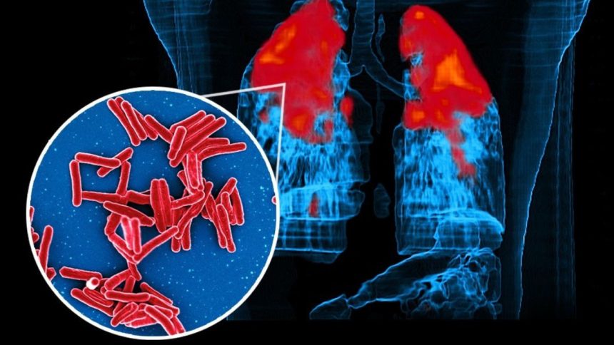Preventable TB deaths remain India’s biggest challenge: Soumya Swaminathan