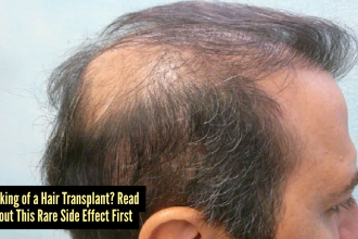 Hidden risks of hair transplants: A rare but serious side effect that no one talk about