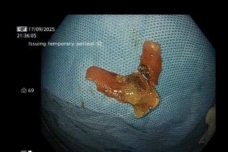 Laser saves man after denture gets stuck in food pipe