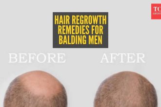 Reverse male pattern baldness with home remedies