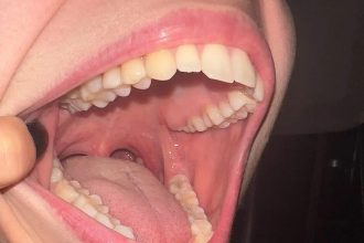 Drug Trials To Regrow Teeth: Japanese team tests TRG-035 to regrow teeth; treatment could arrive by 2030