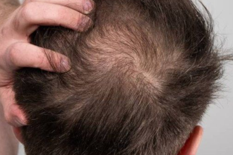 'Hair loss impacted my self-esteem': LeT terrorist says he went for transplant in India
