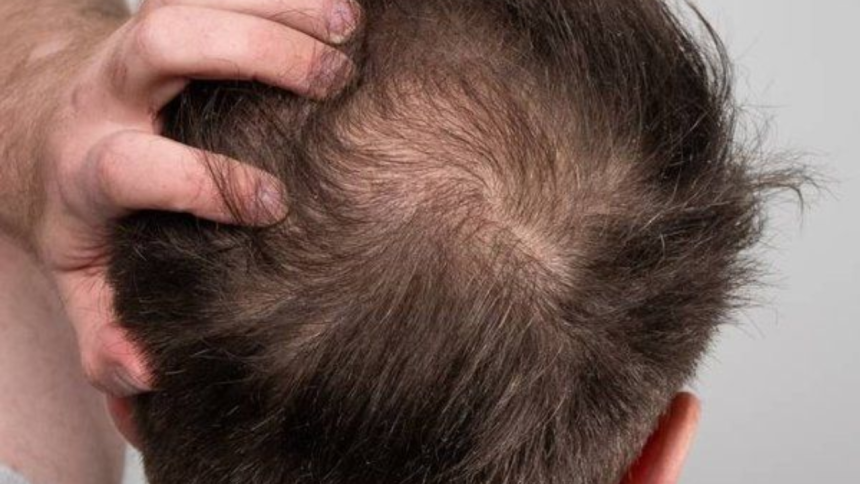 'Hair loss impacted my self-esteem': LeT terrorist says he went for transplant in India