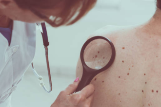 Melanoma cases hit record high in the UK: What it is and how to prevent it
