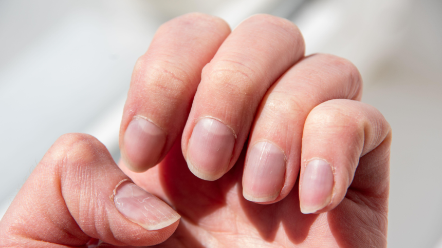 The body check: What your fingernails may reveal about health