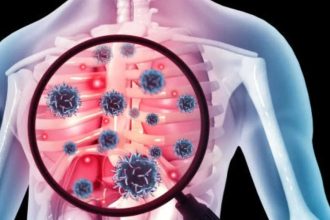 One in three TB cases found in Northeast screening had no symptoms
