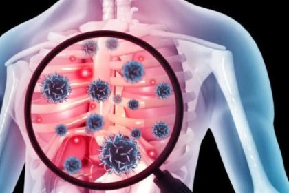 One in three TB cases found in Northeast screening had no symptoms