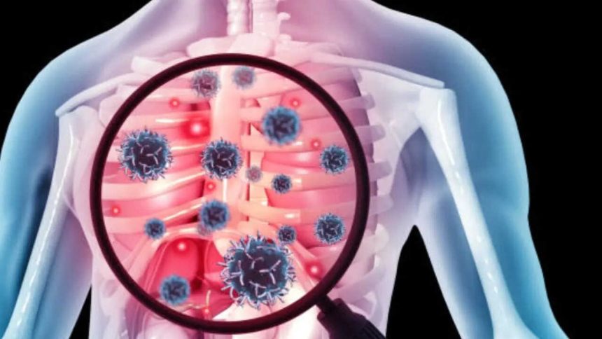 One in three TB cases found in Northeast screening had no symptoms