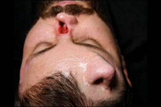 Iraqi surgeon grows nose on patient's forehead in rare reconstruction surgery to correct facial damage in high-voltage electr