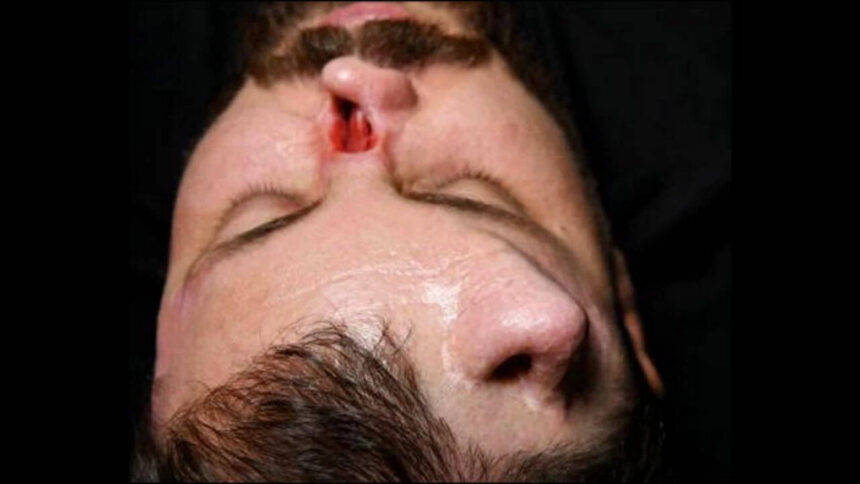 Iraqi surgeon grows nose on patient's forehead in rare reconstruction surgery to correct facial damage in high-voltage electr